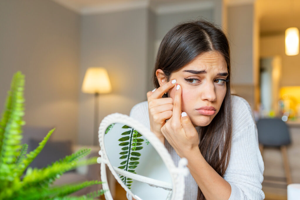 Dites Adieu à l'acné : Comprendre, Prévenir et Traiter