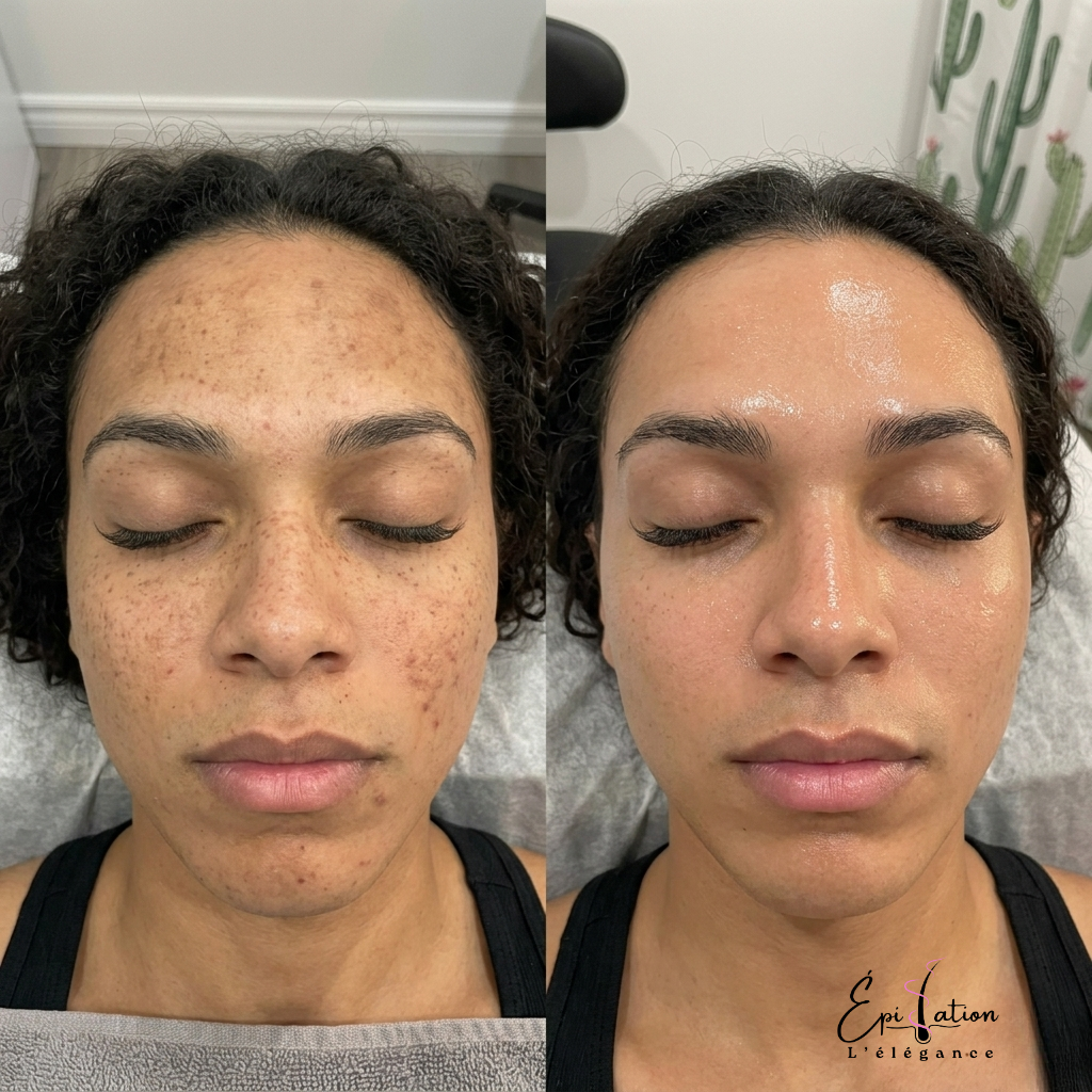 Résultat peeling chimique