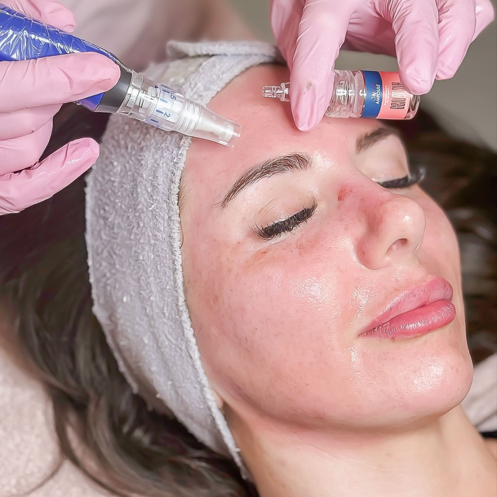 Microneedling à Brossard